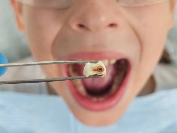 Best Emergency Root Canal Treatment in Pelham, GA
